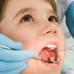 عصب کشی دندان کودکان - درمان ریشه دندان کودکان ، دلایل و مراقبت ها
