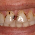 پوسیدگی دندان درکودکان و روش های پیشگیری و درمان