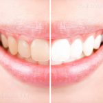 مینای دندان چیست ؟ عواملی که باعث تخریب مینای دندان در کودکان می شود