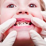 علل پوسیدگی های زودرس دندان های شیری