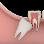 دندان نهفته در کودکان ، علل به وجود آمدن آن و روش های درمان