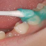 تاثیر فلوراید تراپی بر دندان کودکان و چگونگی انجام فلوراید تراپی برای کودکان