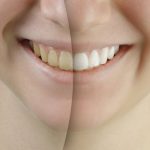 عوامل زرد شدن دندان های کودکان و راه های پیشگیری و درمان زردی دندان