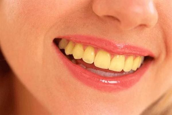 عوامل زرد شدن دندان کودکان