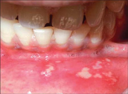 T آفت دهان در کودکان
