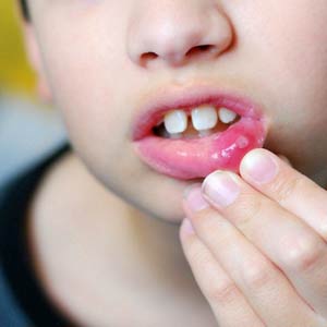 . آفت دهان در کودکان