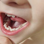 اگر دندان دائمی پشت دندان شیری در می آید ، چه باید کرد ؟