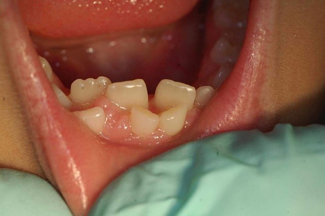 اگر دندان دائمی پشت دندان شیری در می آید ، چه باید کرد