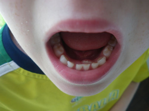 اگر دندان دائمی پشت دندان شیری در می آید چه باید کرد