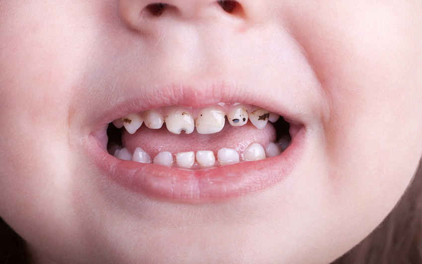 علل حساسیت دندان در کودکان ؟