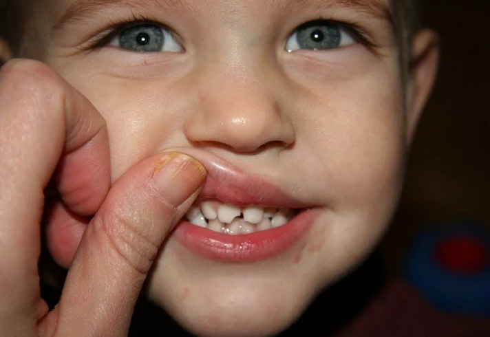 علل حساسیت دندان در کودکان..
