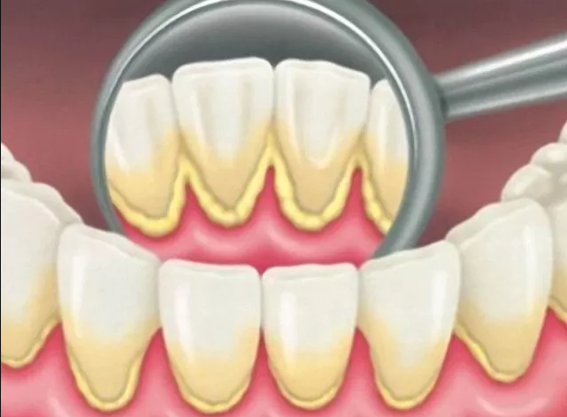 جرم دندان چیست ،.