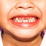 جرم دندان چیست و چه تاثیری بر لثه و دندانهای کودکان دارد؟