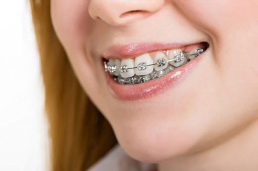 Dental orthodontics 5