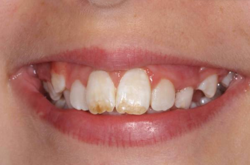 Tooth discoloration 2