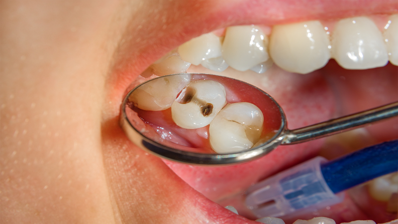 جلوگیری از پوسیدگی دندان کودکان..