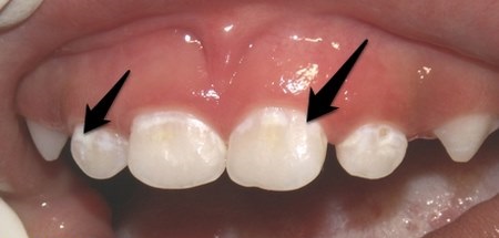 جلوگیری از پوسیدگی دندان کودکان.،