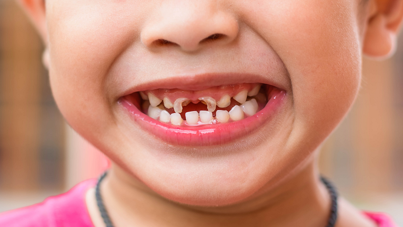 جلوگیری از پوسیدگی دندان کودکان،