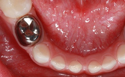 Dental crowns 1