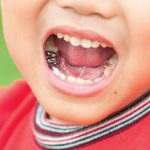روکش دندان شیری چیست و چه کاربردی دارد ؟