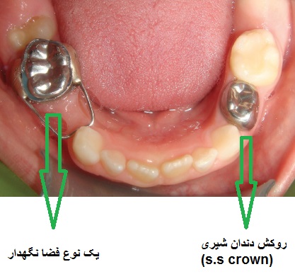Dental crowns 3