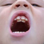 دندان اضافی در کودکان و راه های درمان آن