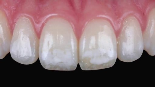 Dental fluorosis 1