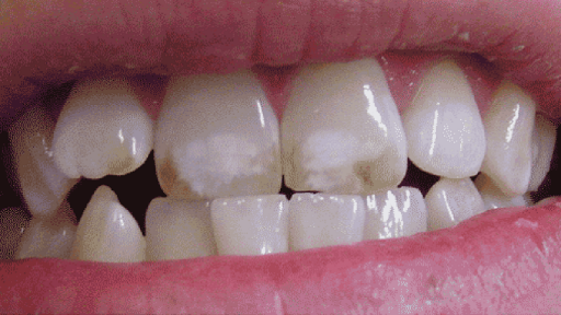 Dental fluorosis 3