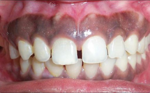 Gum disease 2