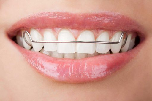 فضانگهدار دندان ها چیست و چه کاربردی دارد ؟ 1
