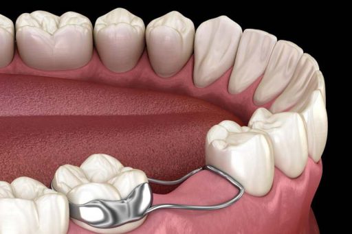 فضانگهدار دندان ها چیست و چه کاربردی دارد ؟ 2