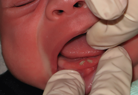 Natal and neonatal teeth 1