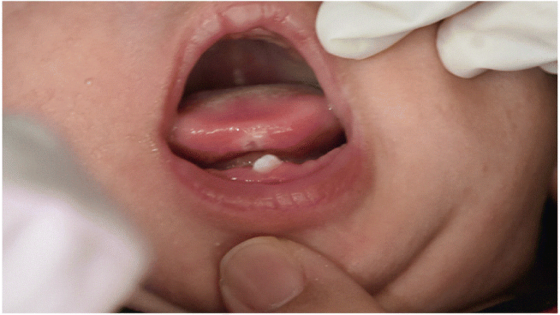 Natal and neonatal teeth 2