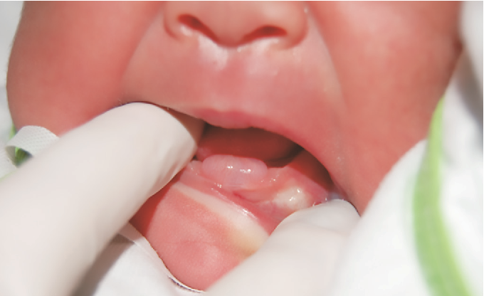 Dental cysts 1