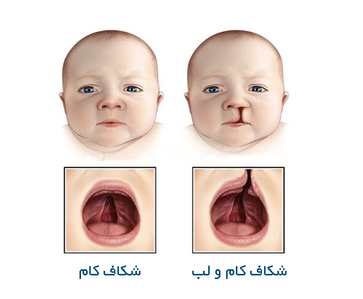 Cleft lip and palate 1