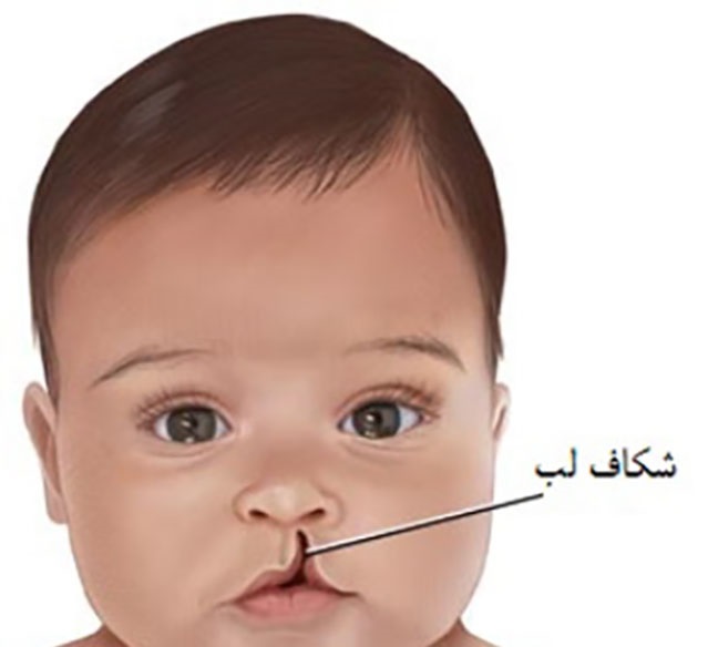 Cleft lip and palate 4