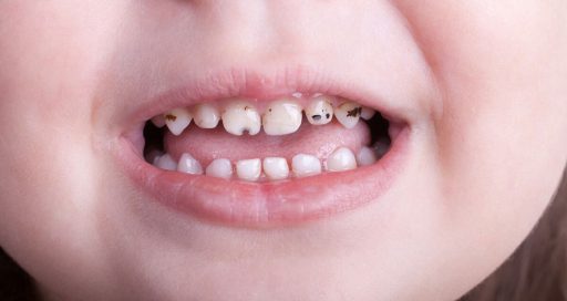 Treatment of black teeth in children 1