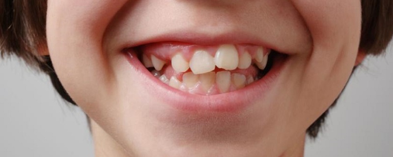 Teething of teeth 1