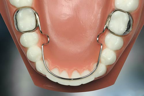 Tooth spacer 5