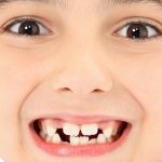 ماملون دندان (برجستگی دندان) چیست ؟