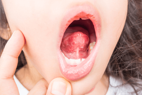 Dry mouth in children 1