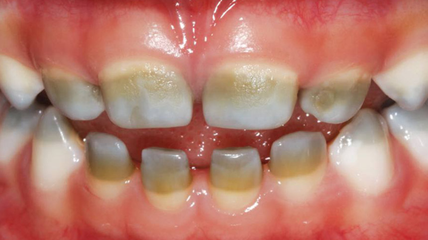 Tooth discoloration in infants 1