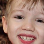 علت تغییر رنگ دندان در نوزادان