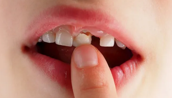 What causes loose teeth in children 2