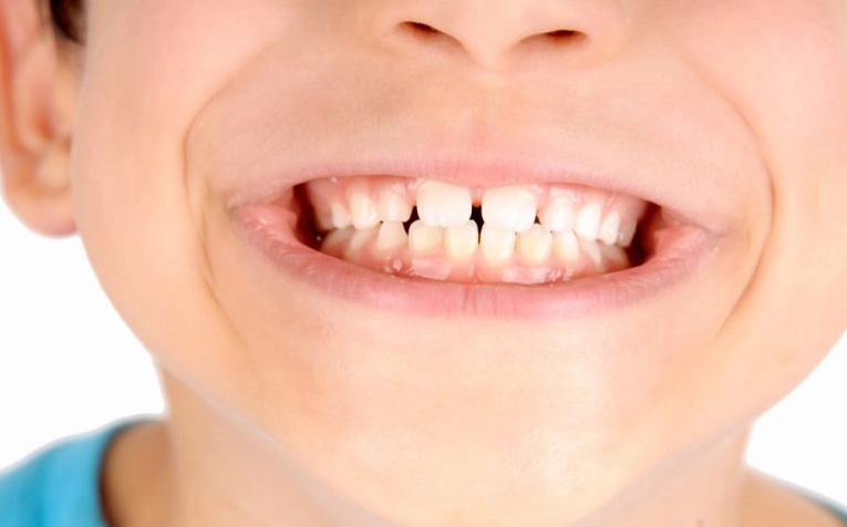 The distance between the teeth in children 2