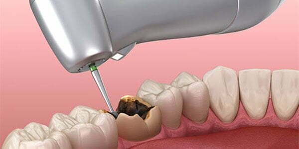 Denervation of milk teeth 2