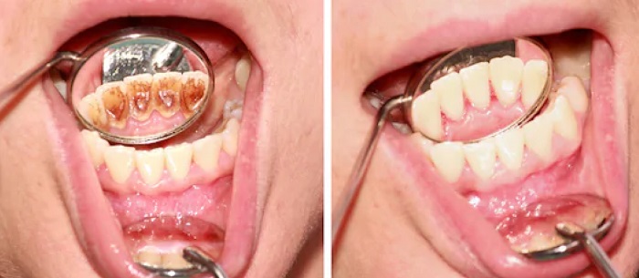 Dental plaque in children 2