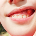 آبسه دندان در کودکان و علائم آن چیست ؟