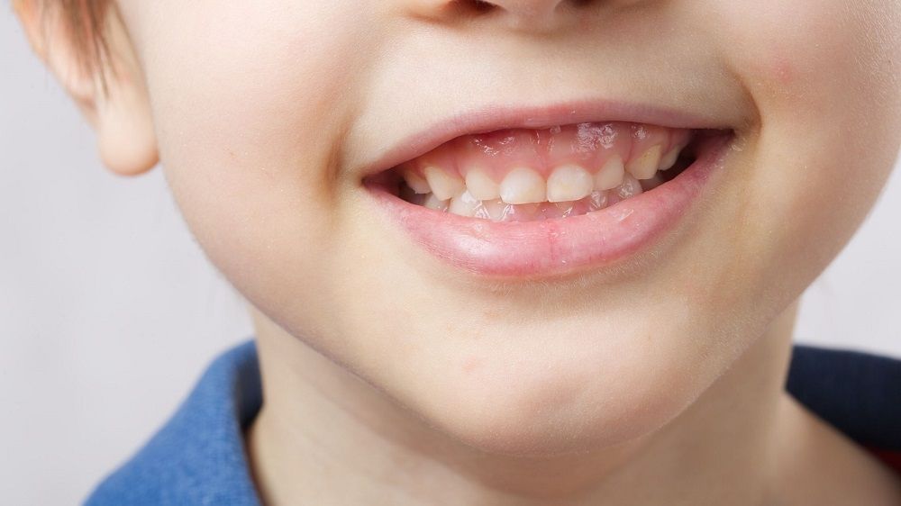 Gum swelling in children 3
