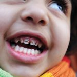 چگونه از پوسیدگی دندان کودکان پیشگیری کنیم ؟